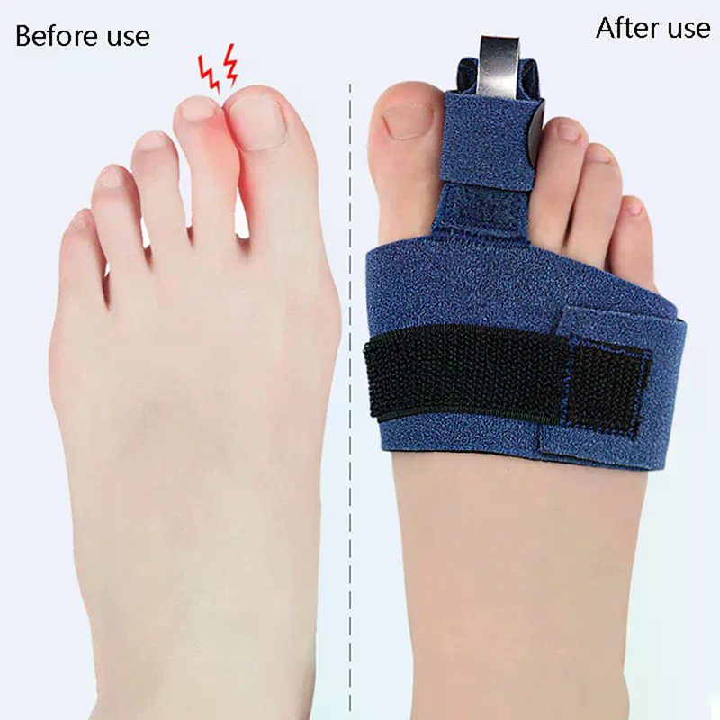 1Pcs Toe Corrector Toe Fractur - Ankle Brace Sock บทวิจารณ์และราคา